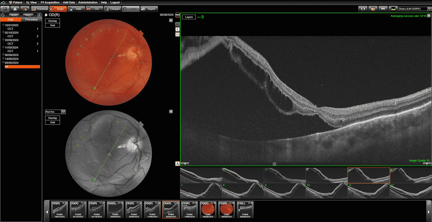 Отслоение сетчатки лечение