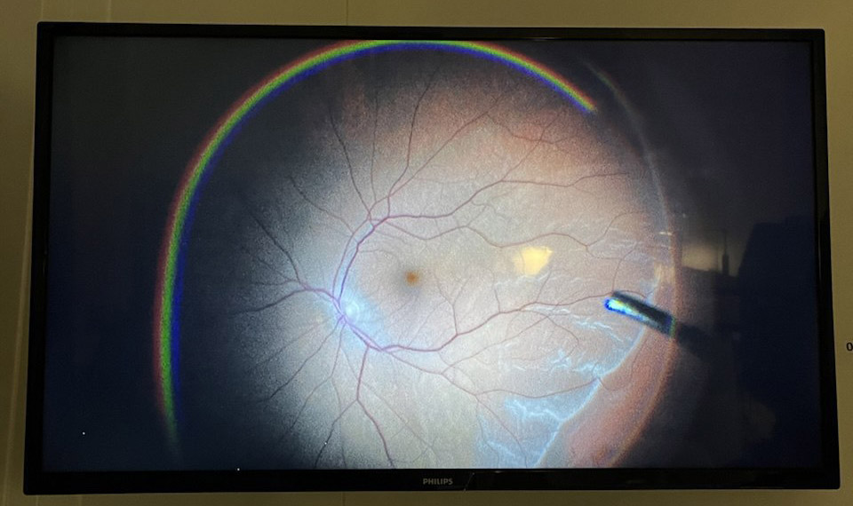 Симптомы и признаки отслоения сетчатки