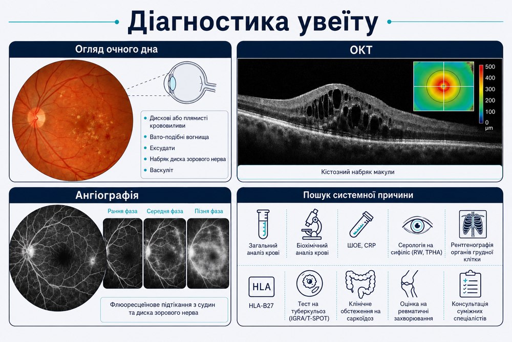 Неінфекційний увеїт - діагностика