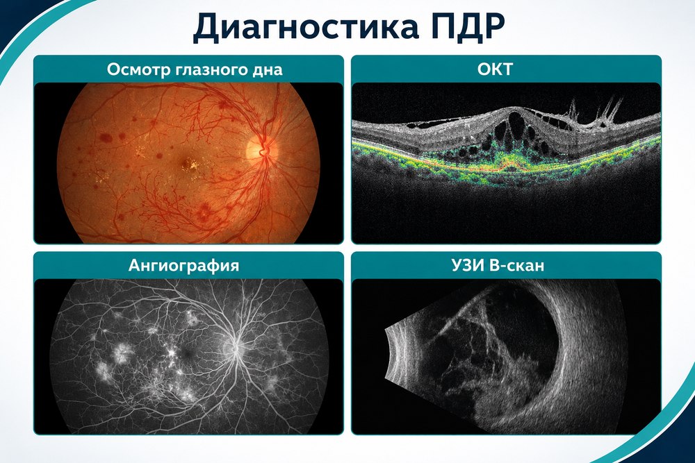 Пролиферативная диабетическая ретинопатия - диагностика
