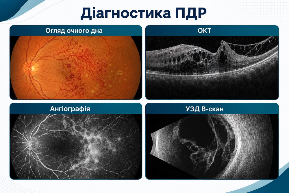Проліферативна діабетична ретинопатія - діагностика