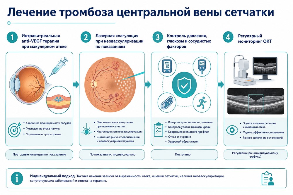 Окклюзия центральной вены сетчатки - лечение