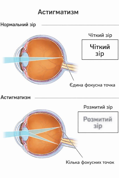 Лікування астигматизму - нормальний зір та астигматизм