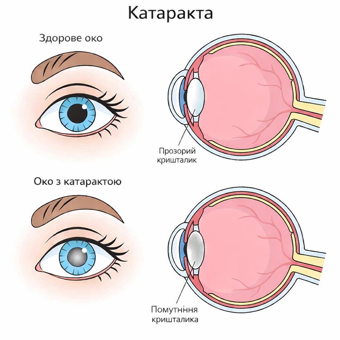 Катаракта - здорове око та око з катарактою